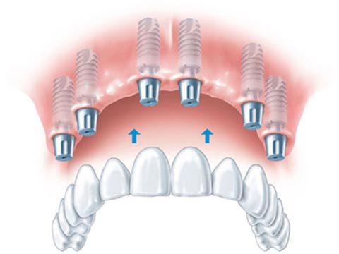 dis-hekimi-hilal-ayva-implant-ustu-protezler dis-hekimi-hilal-ayva-implant-ustu-protezler